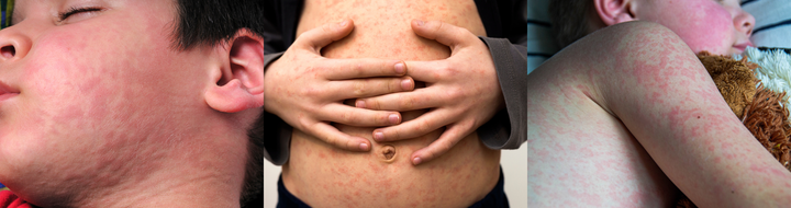 Measles Case Confirmed in Cascade County